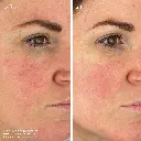youth boost peptide serum_imgCarousel_before and after.webp